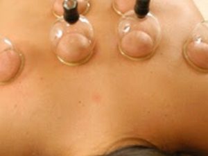 Chinese-Hijma-Cupping